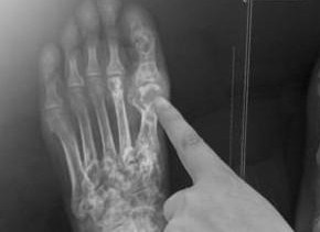 痛風(fēng)治療方法