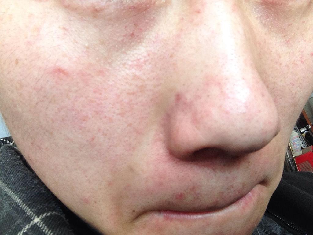 消除臉部紅血絲小妙招