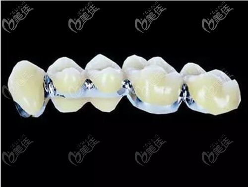 鈷鉻烤瓷牙價格