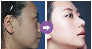 關(guān)于只做鼻翼縮小手術(shù)的費(fèi)用分析，只做鼻翼縮小手術(shù)的費(fèi)用詳解