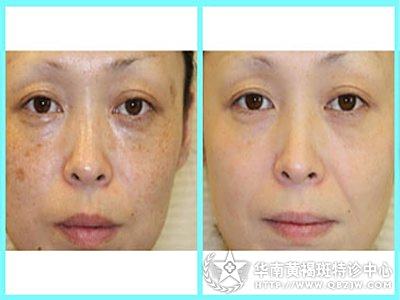 中醫(yī)祛斑最有效的方法，中醫(yī)祛斑有效方法總結(jié)，探索最佳祛斑途徑