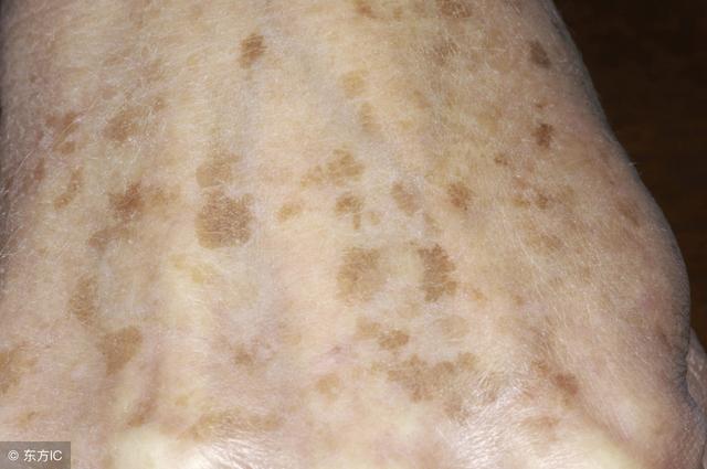 老年斑的形成原因及消除方法，老年斑的形成原因與消除方法全解析