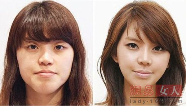 整容前后對照圖片大全，探索美麗轉變的藝術，整容前后對照圖片大全，美麗轉變的藝術探索