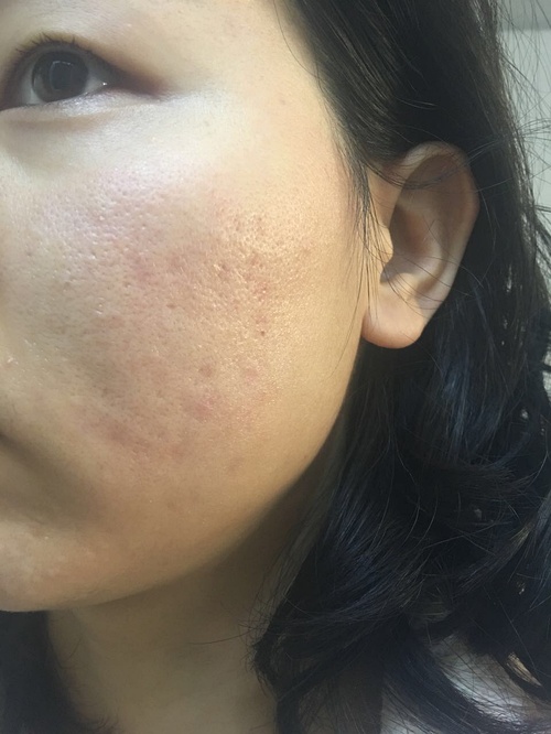 嚴(yán)重痤瘡治療最徹底的方法，全面攻略與最佳實(shí)踐，全面攻略揭秘，最徹底治療嚴(yán)重痤瘡的最佳實(shí)踐與最佳方法