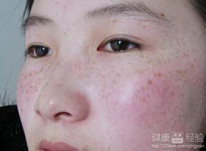 怎樣去除黃褐斑最快最有效，全面解析黃褐斑的成因與有效治療方法，全面解析黃褐斑成因及快速有效的去除方法