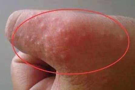 生殖上長小水泡的原因，深度解析與應(yīng)對建議，生殖部位小水泡成因深度解析及應(yīng)對建議