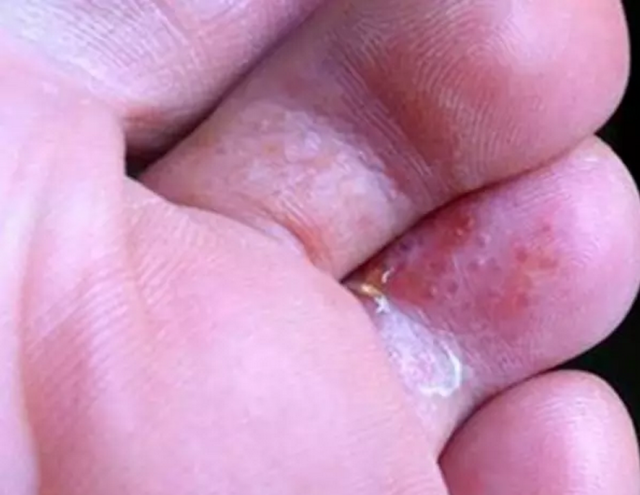 濕疹和腳氣區(qū)別圖，深入了解兩種常見皮膚狀況，濕疹與腳氣區(qū)別詳解，直觀圖表解析兩種常見皮膚狀況