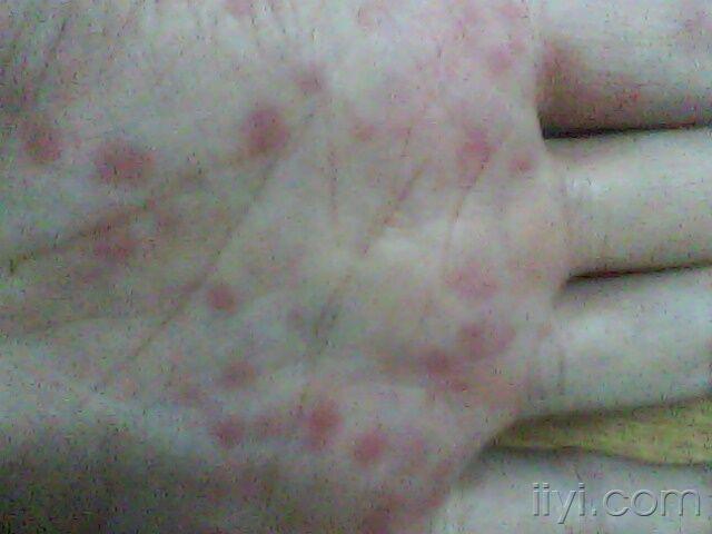 關于梅毒引發(fā)的紅斑特征及識別方法，梅毒引發(fā)紅斑的特征與識別方法指南