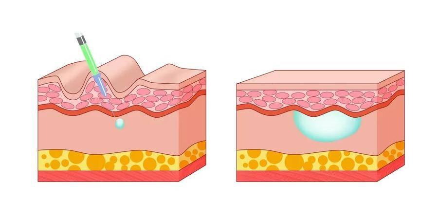 法令紋去除最安全永久的方法，全面解析與實用建議，全面解析法令紋永久安全去除法，實用建議與最佳實踐
