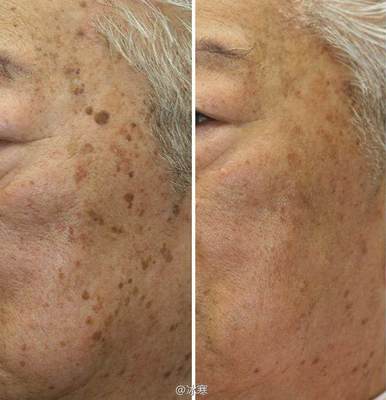 如何有效去除老年斑——全面解析，全面解析，有效去除老年斑的方法