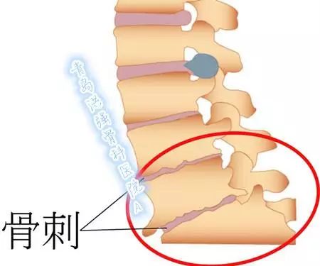 骨刺的最佳治療方法，骨刺的最佳治療方法解析
